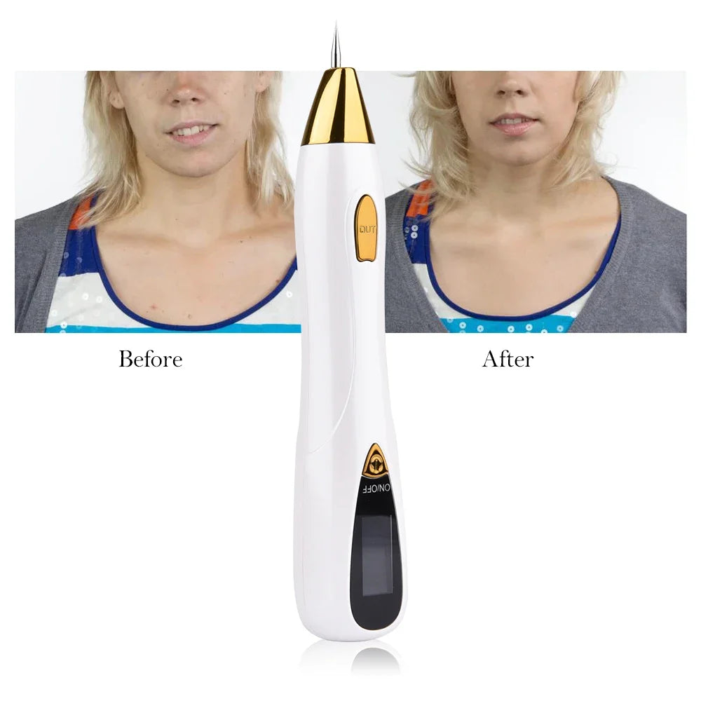 Freckle Pen Caneta Plasma Mole - Removedora De Manchas, Sinais, Verrugas, Tatuagens e outros