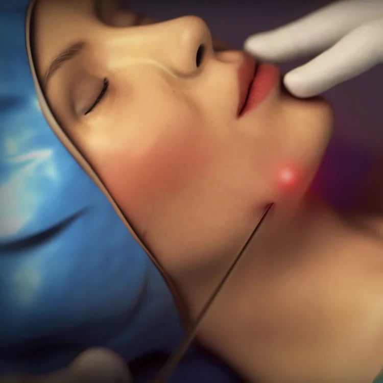 Fibra Óptica Endolaser Endolift 200μm a 800μm Conector SMA905 e FC – Compatível com Laser Diodo 350 - 2500nm