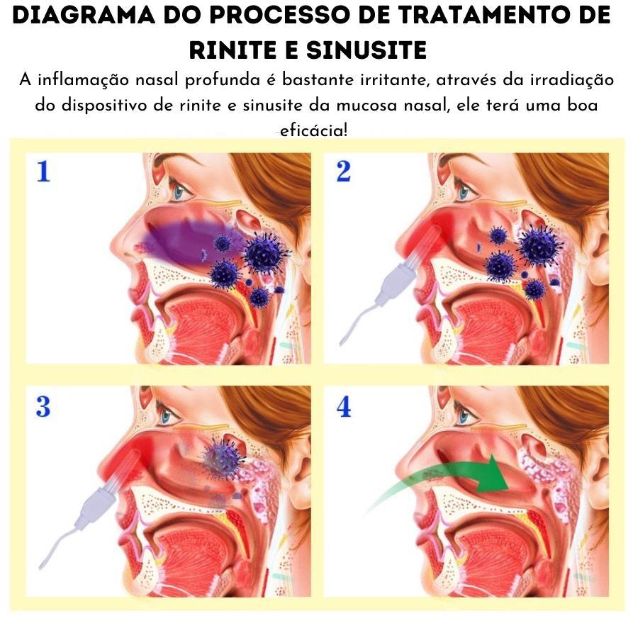 Bionase Laser 100% Original | Tratamento Rinite Sinusite Alergia - Picuí Magazine