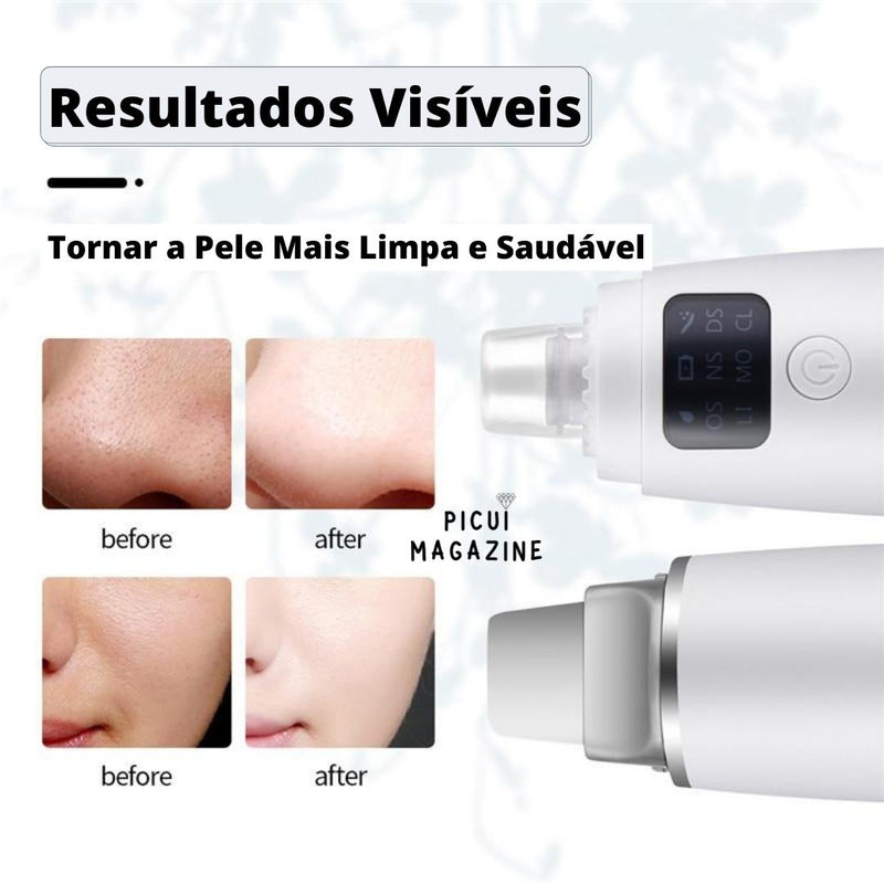 New Skin Care Clean 2 em 1 - Peeling Ultrassônico + Peeling de Diamante - Picuí Magazine